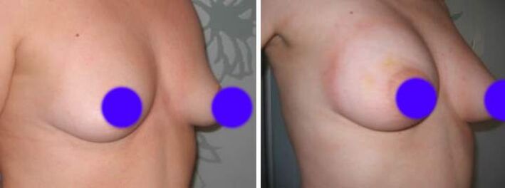 Seno prima e dopo l'introduzione di riempitivi basati sull'acido ialuronico