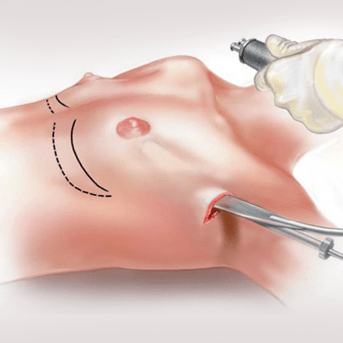 Aumento del seno endoscopico